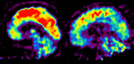 alzheimer